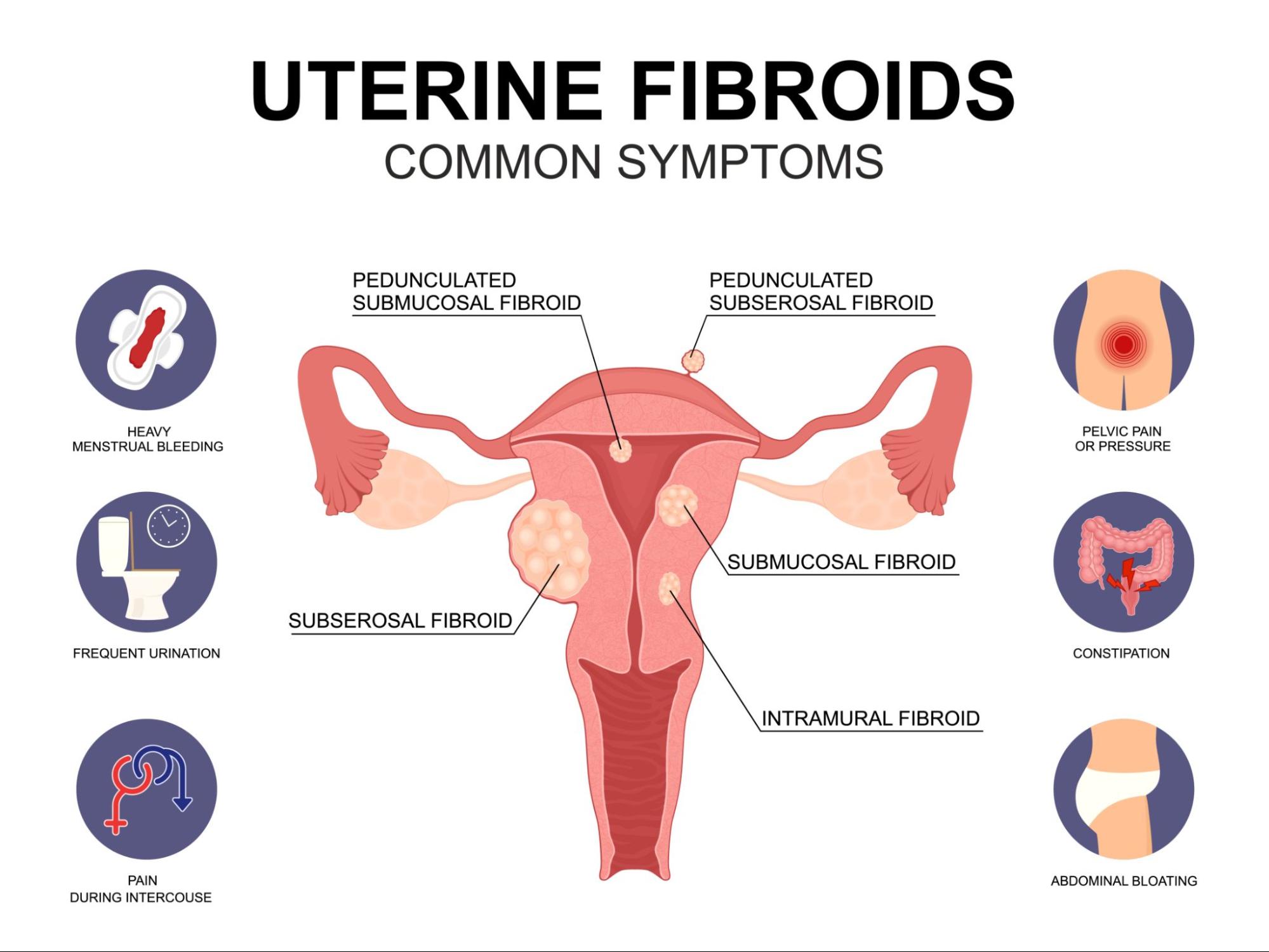 SYMPTOMS AND CAUSES OF FIBROID 